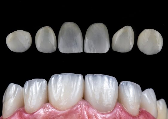 Dán sứ Veneer