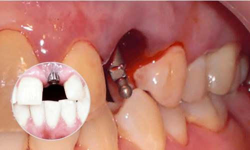 Chảy máu kéo dài sau hậu phẫu thuật
