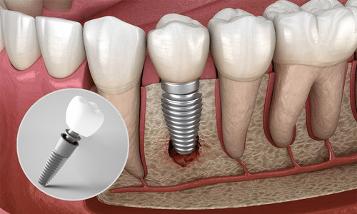 Nhiễm trùng vùng trồng implant
