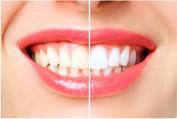 Có nên tẩy trắng răng