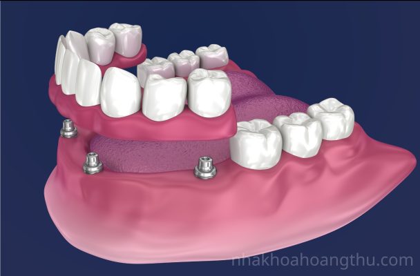 Trồng răng implant All On 4